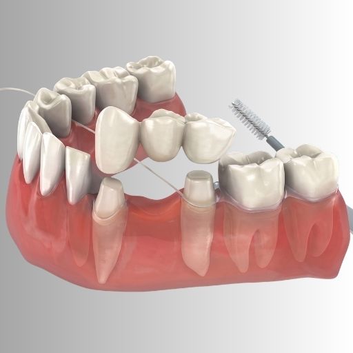 Permanently Fixed Teeth (Crown & Bridge)